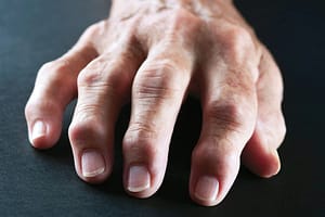 Man hand with Rheumatoid Arthritis