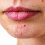 Women With Acne Skin