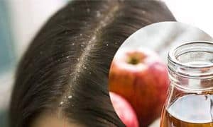Apple Cider Vinegar for Dandruff 